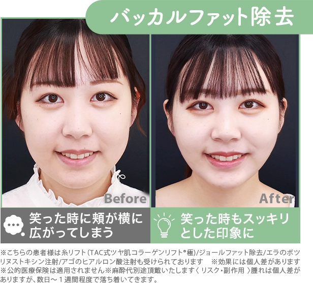バッカルファット除去