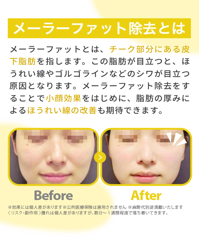 メーラーファット除去とは
