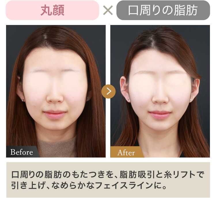 丸顔 × 口周りの脂肪 口周りの脂肪のもたつきを、脂肪吸引と糸リフトで引き上げ、なめらかなフェイスラインに。