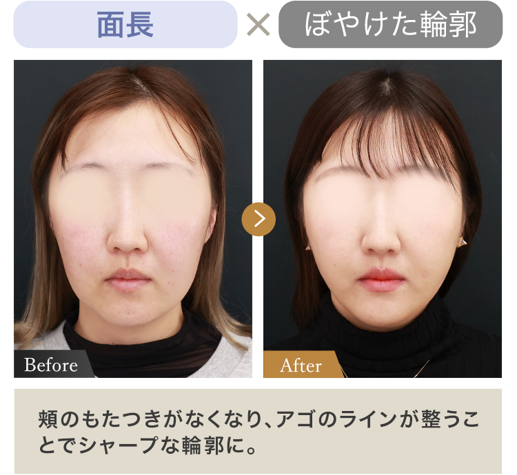 面長 × ぼやけた輪郭 頬のもたつきがなくなり、 アゴのラインが整うことでシャープな輪郭に。