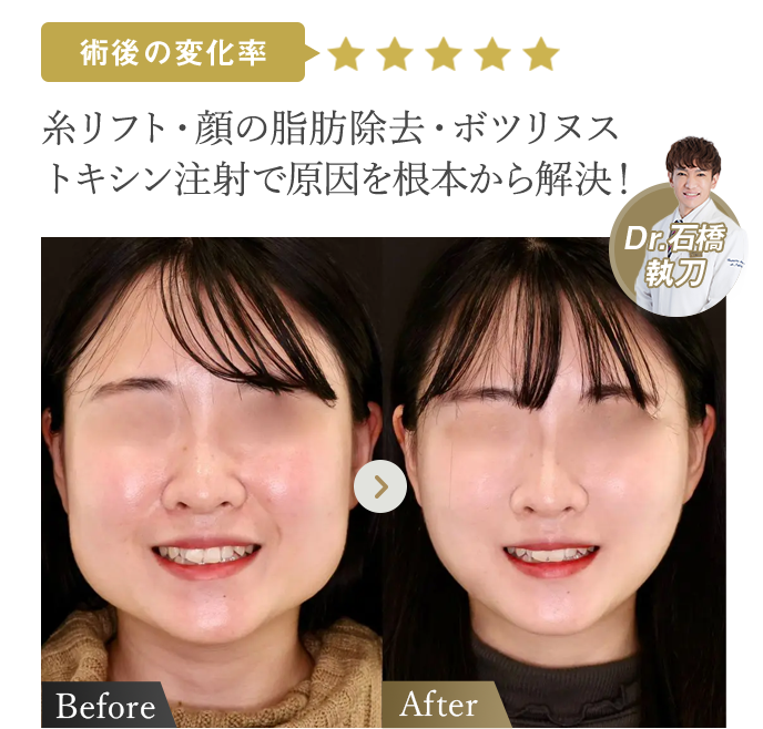 術後の変化率★★★★★ | 糸リフト・顔の脂肪除去・ボツリヌストキシン注射で原因を根本から解決！（Dr石橋執刀） | 症例写真