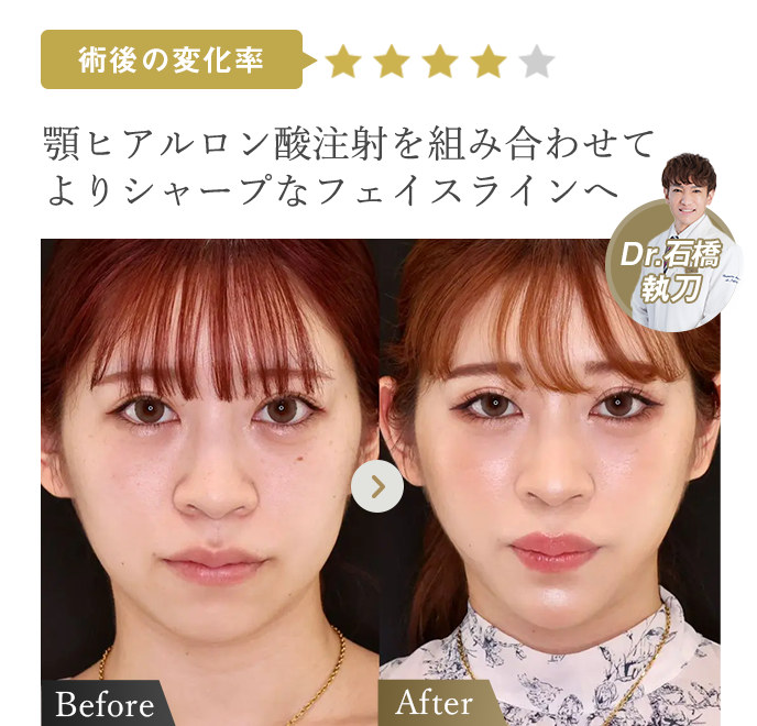 術後の変化率★★★★ | 顎ヒアルロン酸注射を組み合わせてよりシャープなフェイスラインへ（Dr石橋執刀） | 症例写真