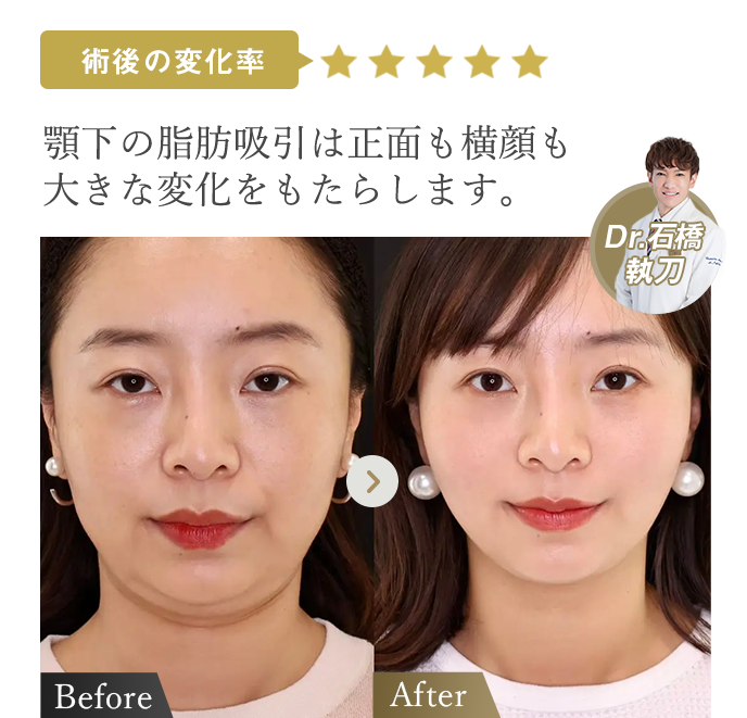 術後の変化率★★★★★ | 顎下の脂肪吸引は正面も横顔も大きな変化をもたらします。（Dr石橋執刀） | 症例写真