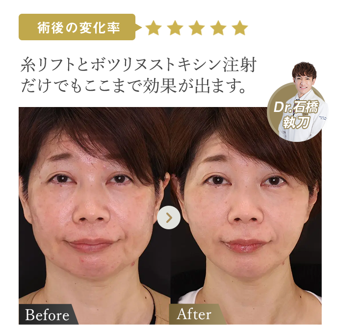 術後の変化率★★★★★ | 糸リフトとボツリヌストキシン注射だけでもここまで効果が出ます。（Dr石橋執刀） | 症例写真