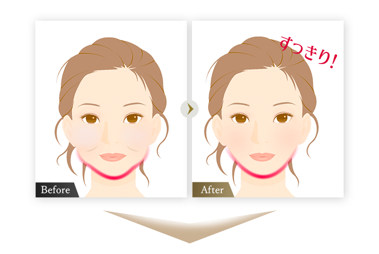 症例イラスト