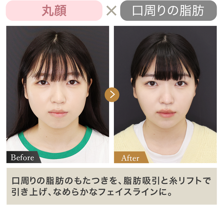 丸顔 × 口周りの脂肪 口周りの脂肪のもたつきを、脂肪吸引と糸リフトで引き上げ、なめらかなフェイスラインに。