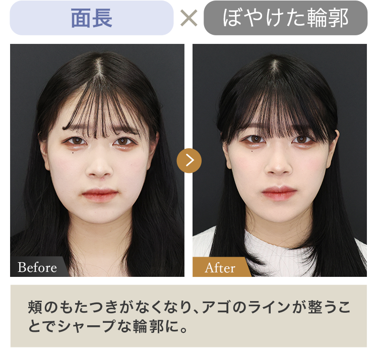 面長 × ぼやけた輪郭 頬のもたつきがなくなり、 アゴのラインが整うことでシャープな輪郭に。