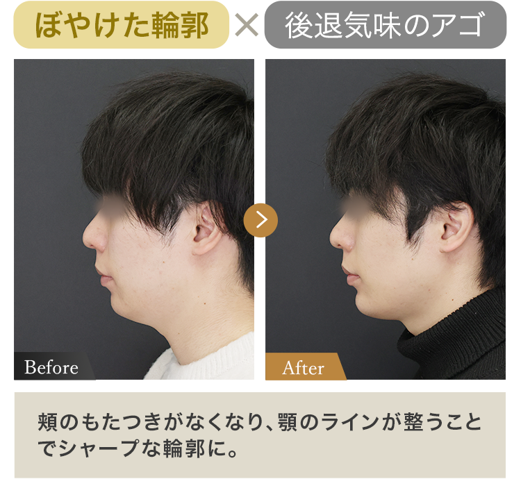 ぼやけた輪郭 × 後退気味のアゴ 頬のもたつきがなくなり、 顎のラインが整うことでシャープな輪郭に。
