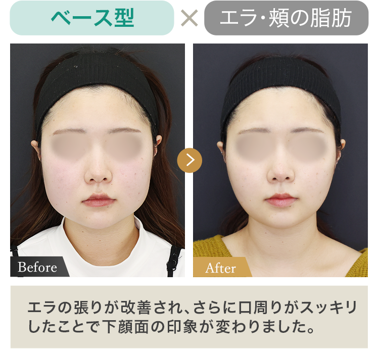 ベース型 × エラ・頬の脂肪 エラの張りが改善され、さらに口周りがスッキリしたことで下顔面の印象が変わりました