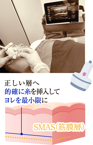 正しい層へ的確に糸を挿入してヨレを最小限に