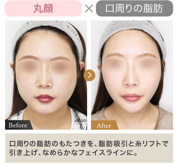 丸顔 × 口周りの脂肪 口周りの脂肪のもたつきを、脂肪吸引と糸リフトで引き上げ、なめらかなフェイスラインに。
