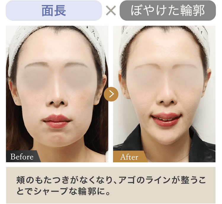 面長 × ぼやけた輪郭 頬のもたつきがなくなり、 アゴのラインが整うことでシャープな輪郭に。