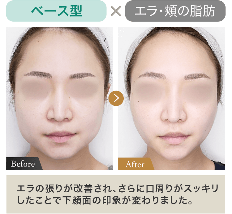 ベース型 × エラ・頬の脂肪 エラの張りが改善され、さらに口周りがスッキリしたことで下顔面の印象が変わりました