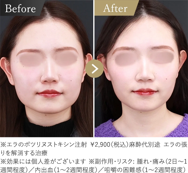 エラボト注射 症例
