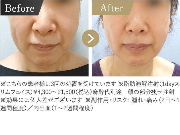 顔の脂肪溶解注射 症例