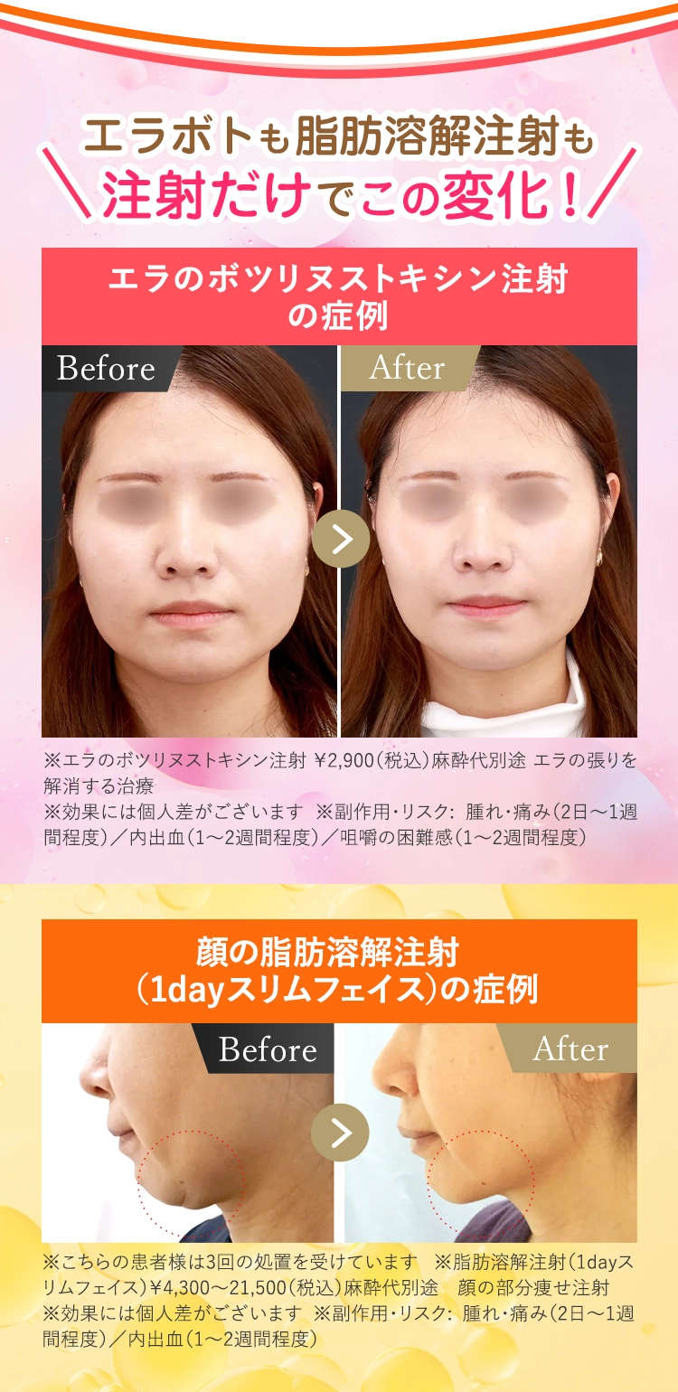 エラボトも脂肪溶解注射も注射だけでこの変化！