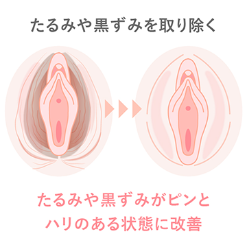 大陰唇たるみ除去の説明図