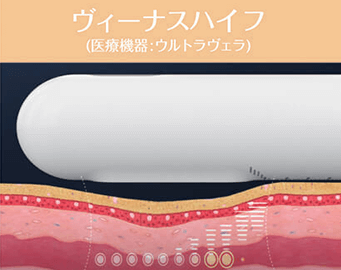 ヴィーナスハイフ