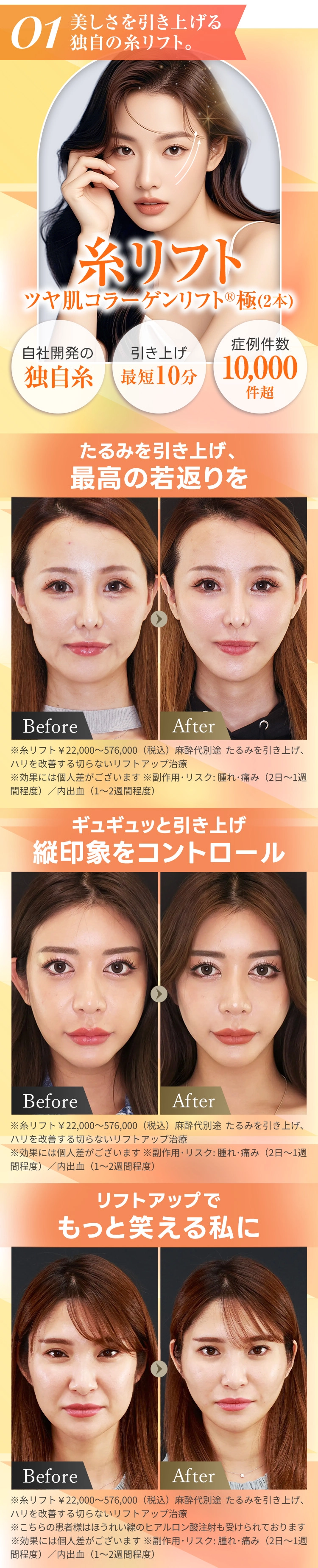 糸リフト 　ツヤ肌コラーゲンリフト®極(2本)