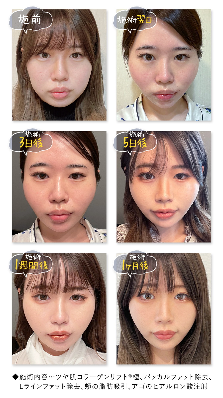 術前>施術翌日>3日後>5日後>1週間後>1ヶ月後