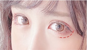 グラマラスライン（タレ目形成）
