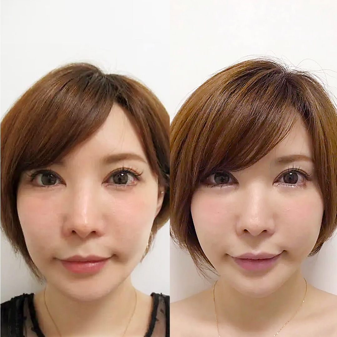 里美ゆりあ様のツヤ肌コラーゲンリフトの一週間経過_正面症例写真