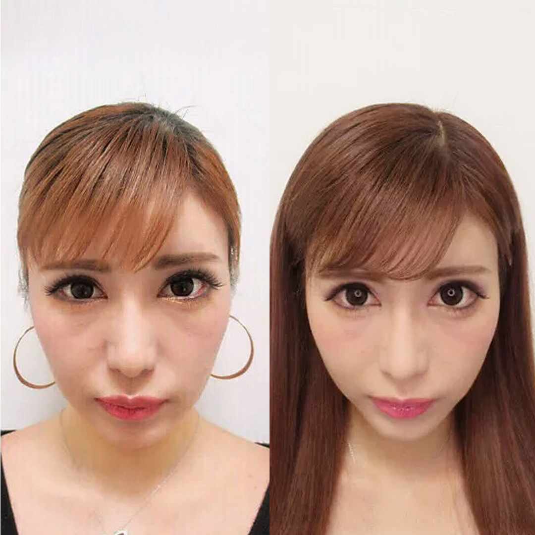 水輝聖羅さまTAC式ツヤ肌コラーゲンリフト正面症例写真