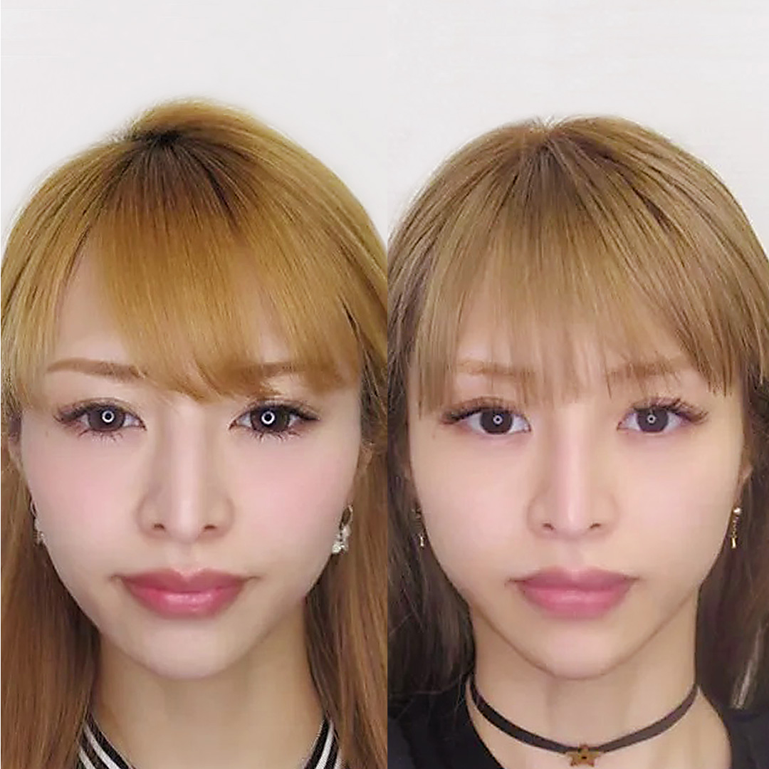 門りょう様のツヤ肌コラーゲンリフト症例写真