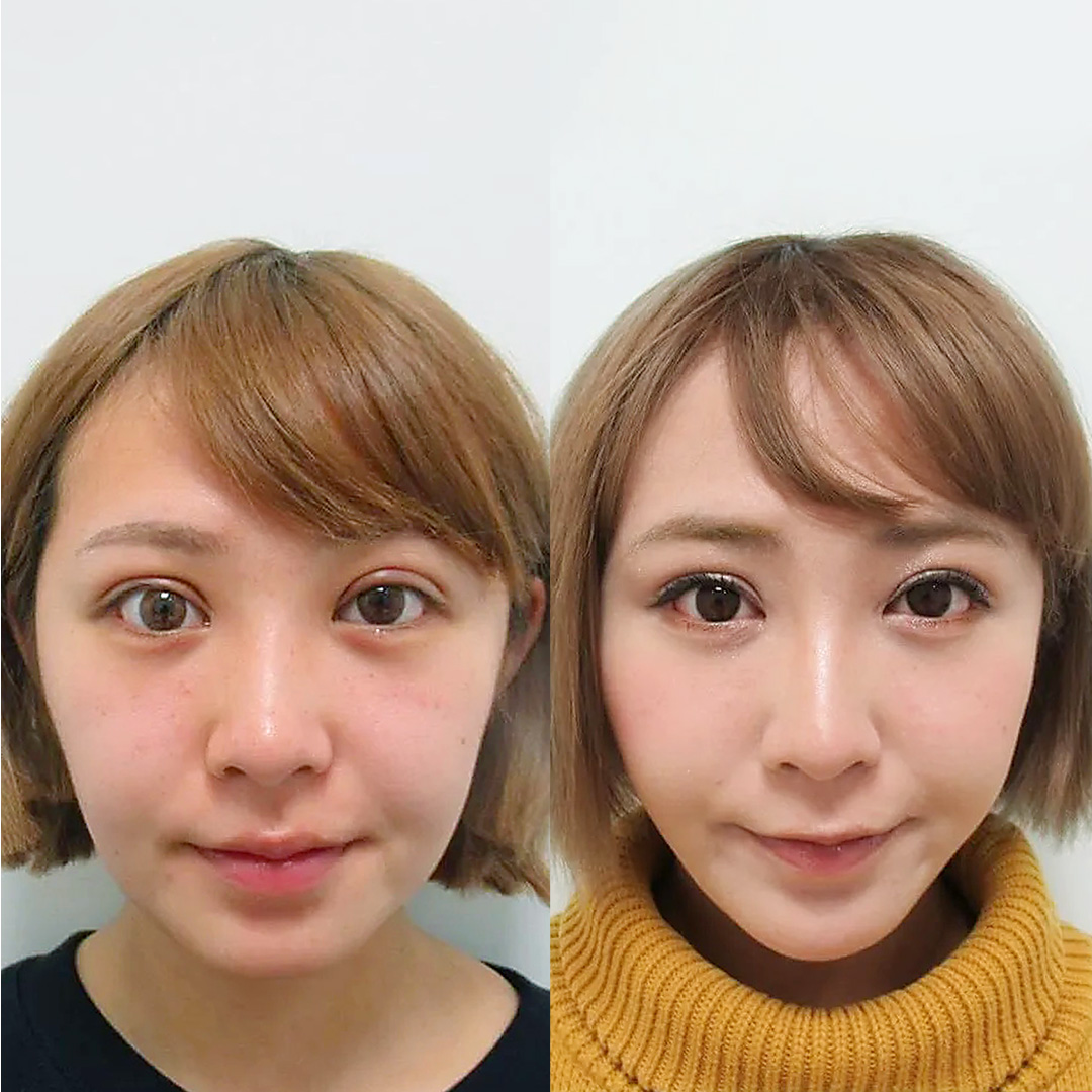 【てんちむ様】TAC式ツヤ肌コラーゲンリフト一か月経過_正面症例写真