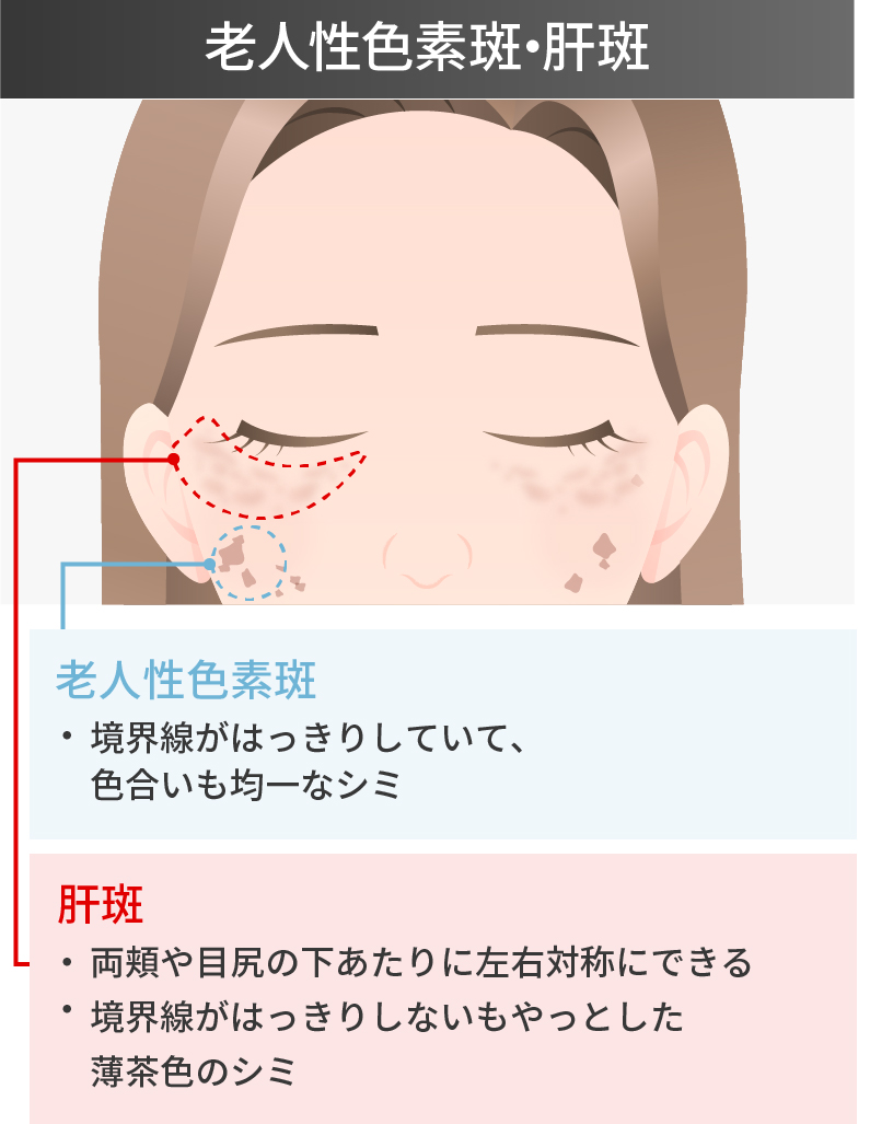 老人性色素斑・肝斑