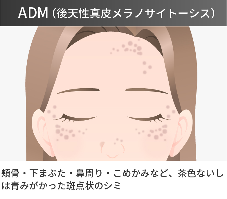 ADM（後天性真皮メラノサイトーシス）