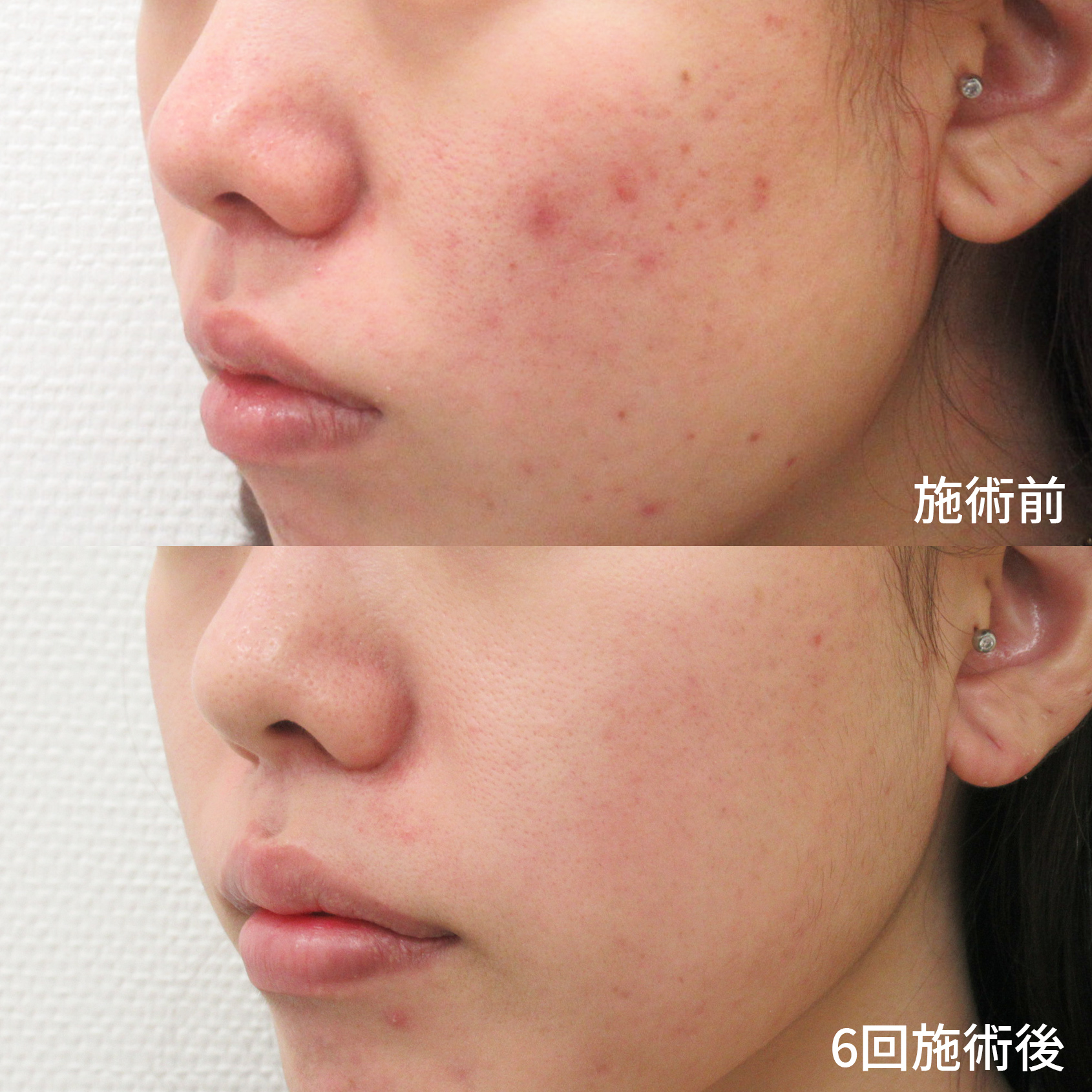 フォトシルクプラス光治療の症例写真 施術前後 