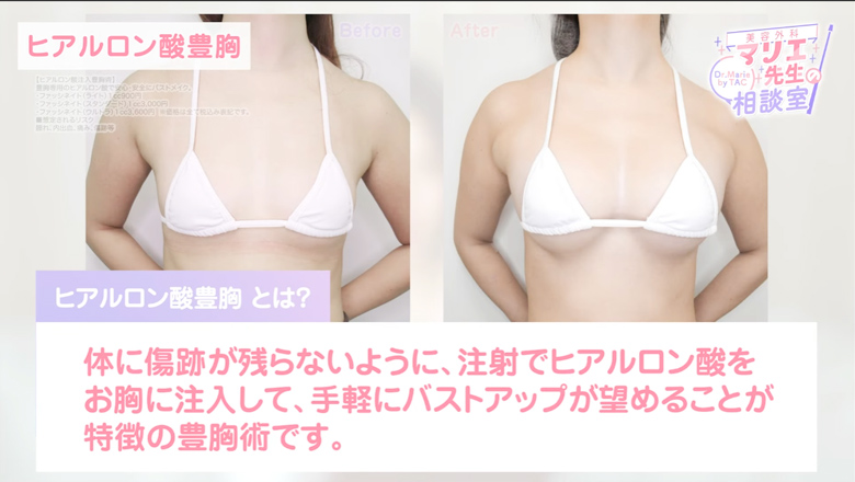 ヒアルロン酸豊胸の術前術後の施術写真