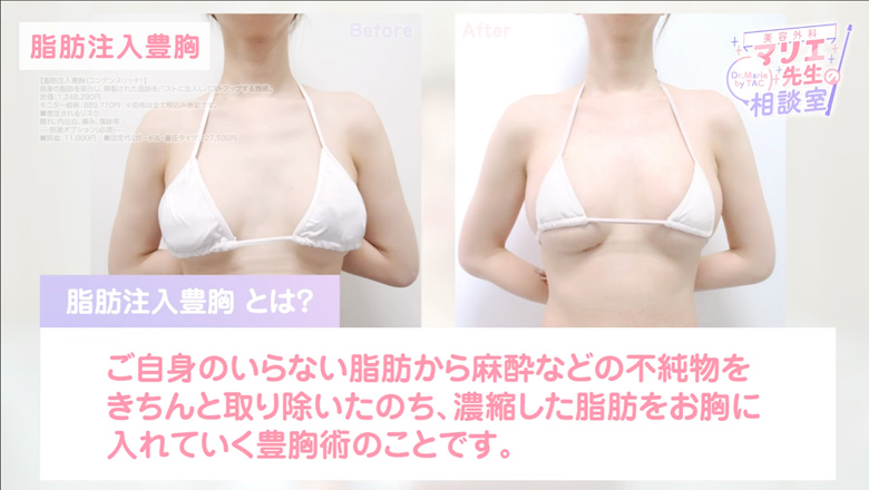 脂肪注入豊胸の術前術後の施術写真