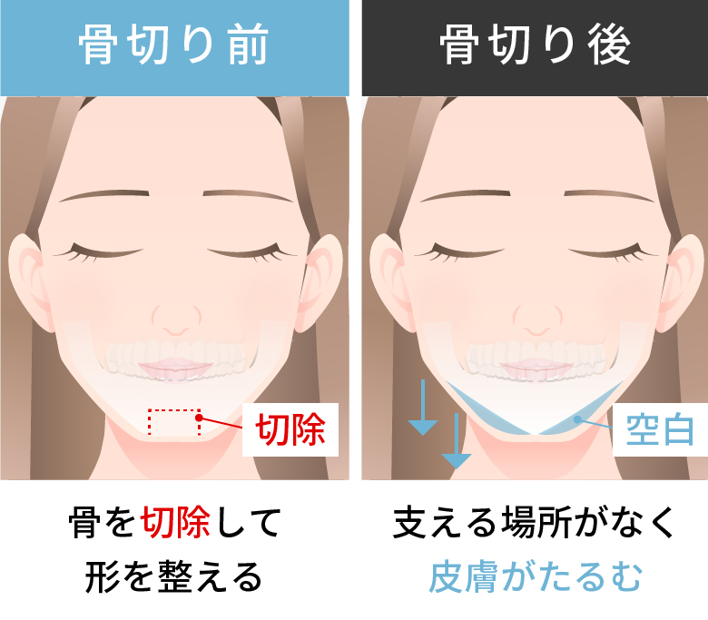 骨切り手術によってたるみが発生するのはなぜ？