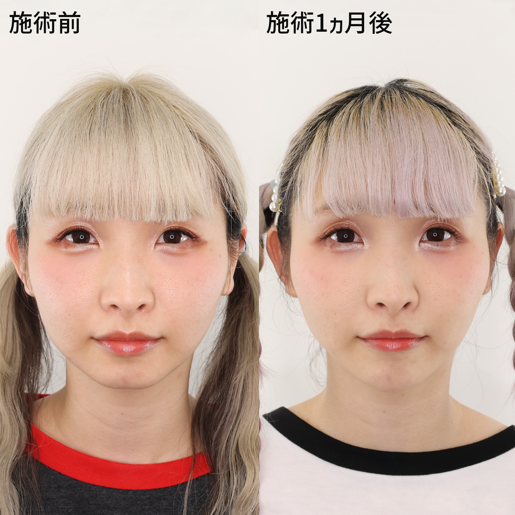 ジョールファット除去/TAC式 ツヤ肌コラーゲンリフト®/顎のヒアルロン酸注射の症例写真 施術前後 1ヵ月