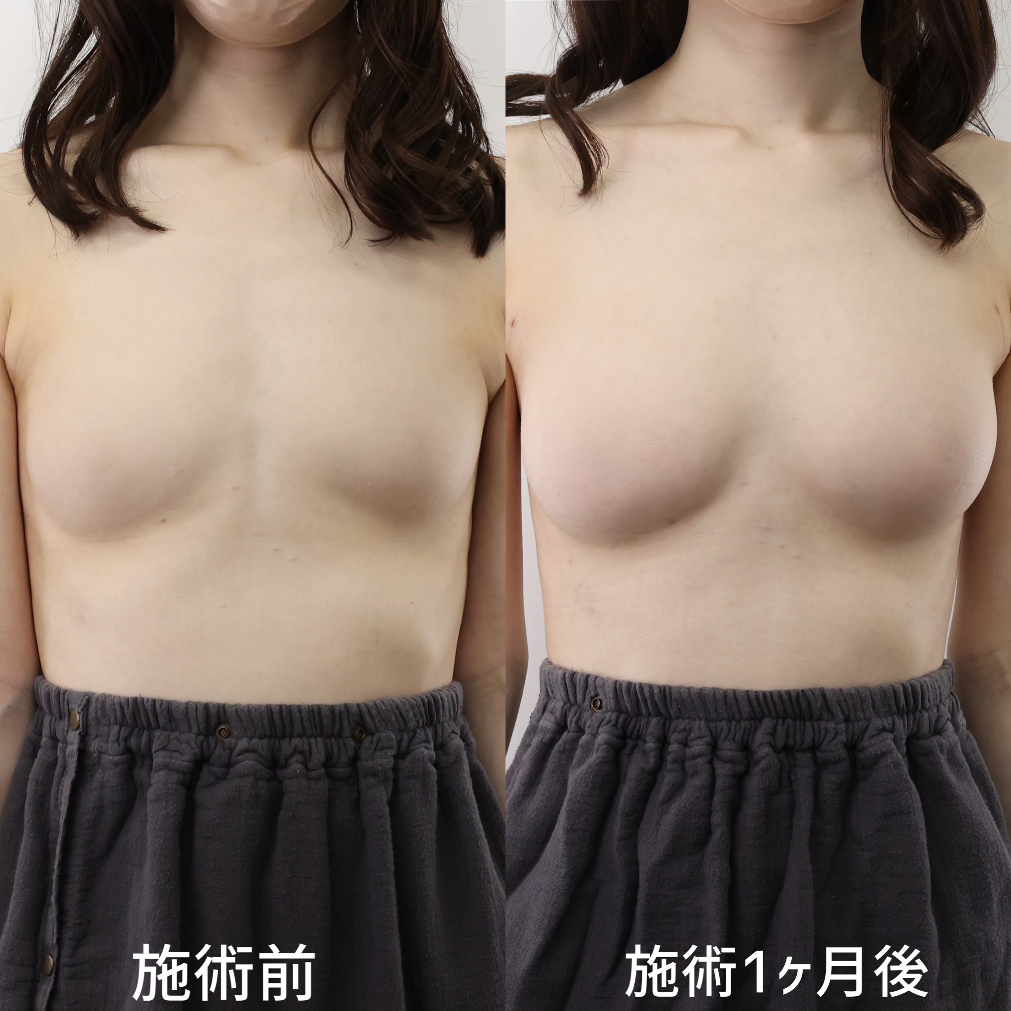 シリコンバッグ豊胸（人工乳腺バッグ）の症例写真 施術前後 １ヵ月