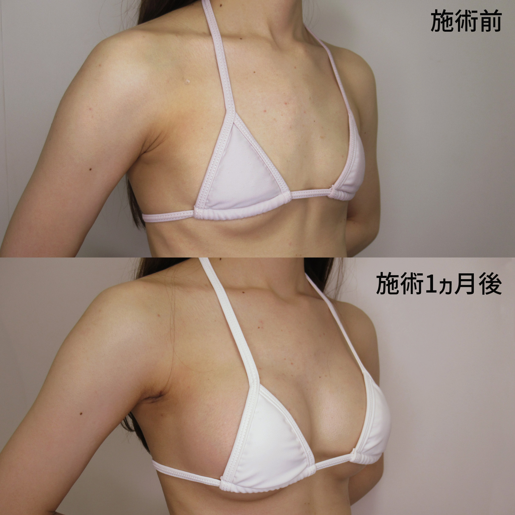 シリコンバッグ豊胸（人工乳腺バッグ）の症例写真 施術前後 １ヵ月