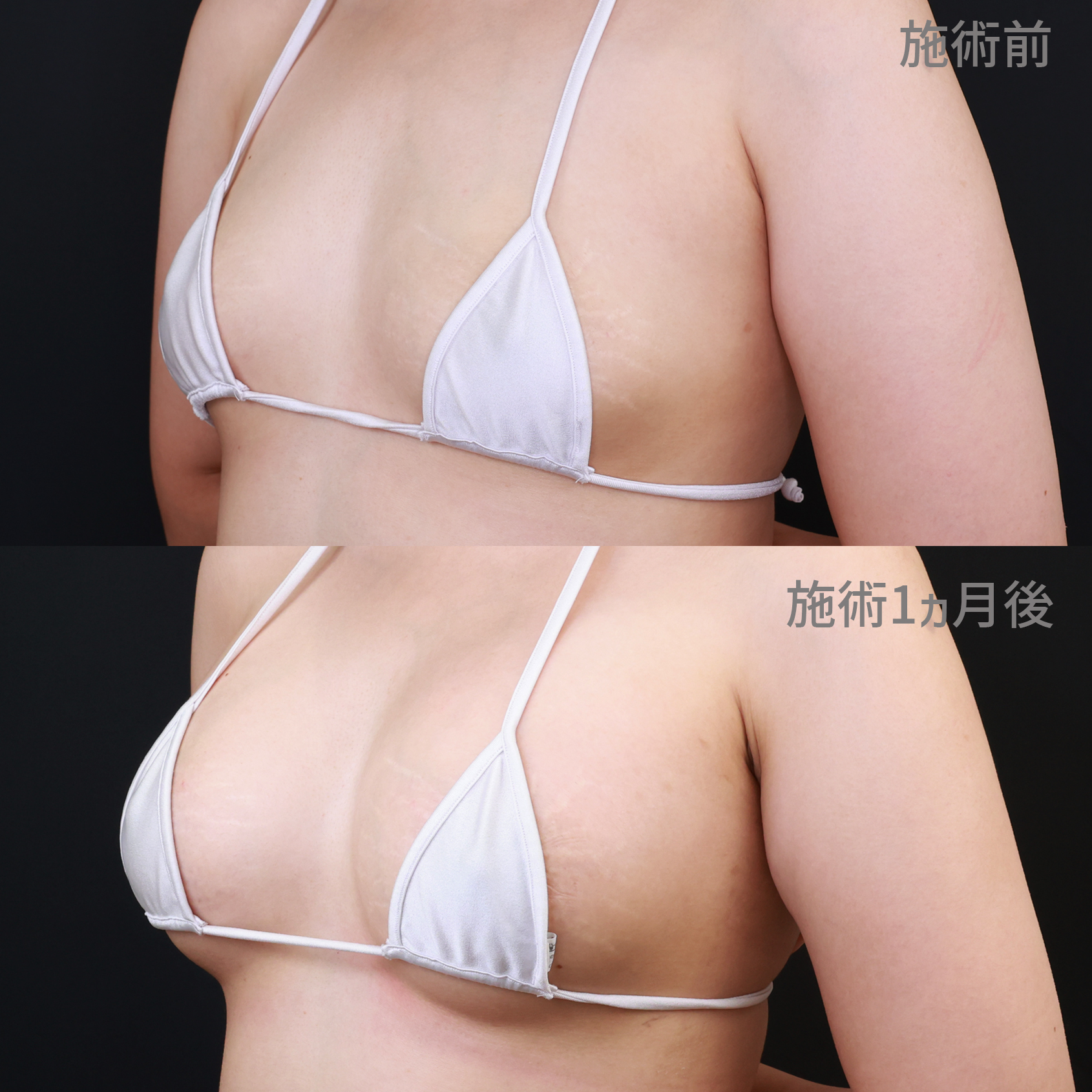 シリコンバッグ豊胸（人工乳腺バッグ）/乳頭縮小術の症例写真 施術前後 1ヵ月