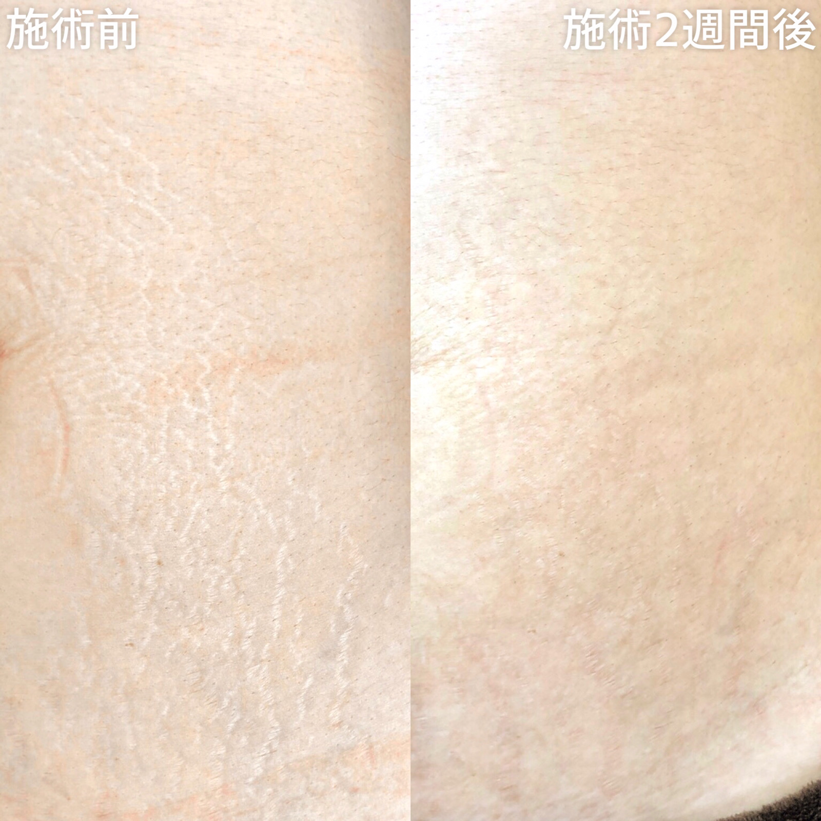 アートメイクSkin52（妊娠線・肉割れ・ストレッチマーク・リスカ跡・傷跡修正）の症例写真 施術前後 