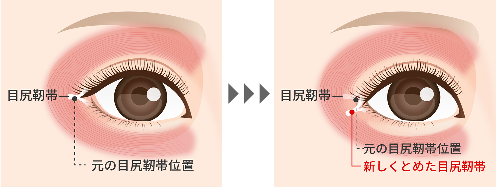 目尻靭帯移動術について