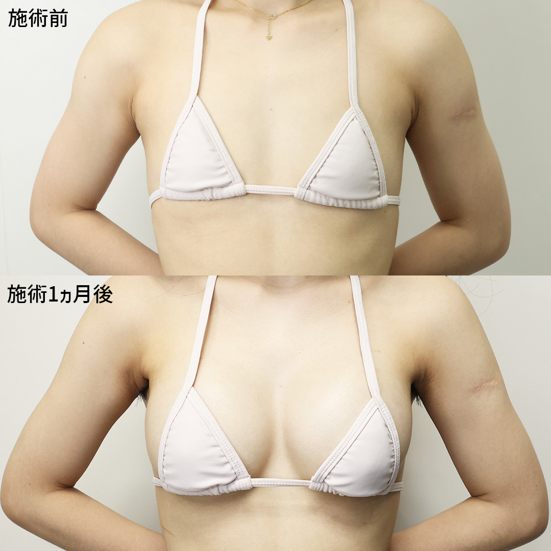 シリコンバッグ豊胸（人工乳腺バッグ）の症例写真 施術前後 