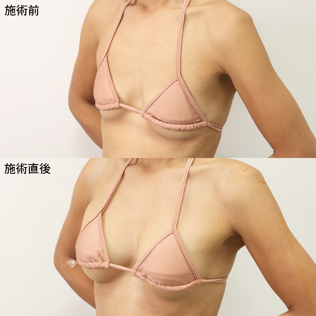 ヒアルロン酸注入豊胸術（グラビアバスト）の症例写真 施術前後 