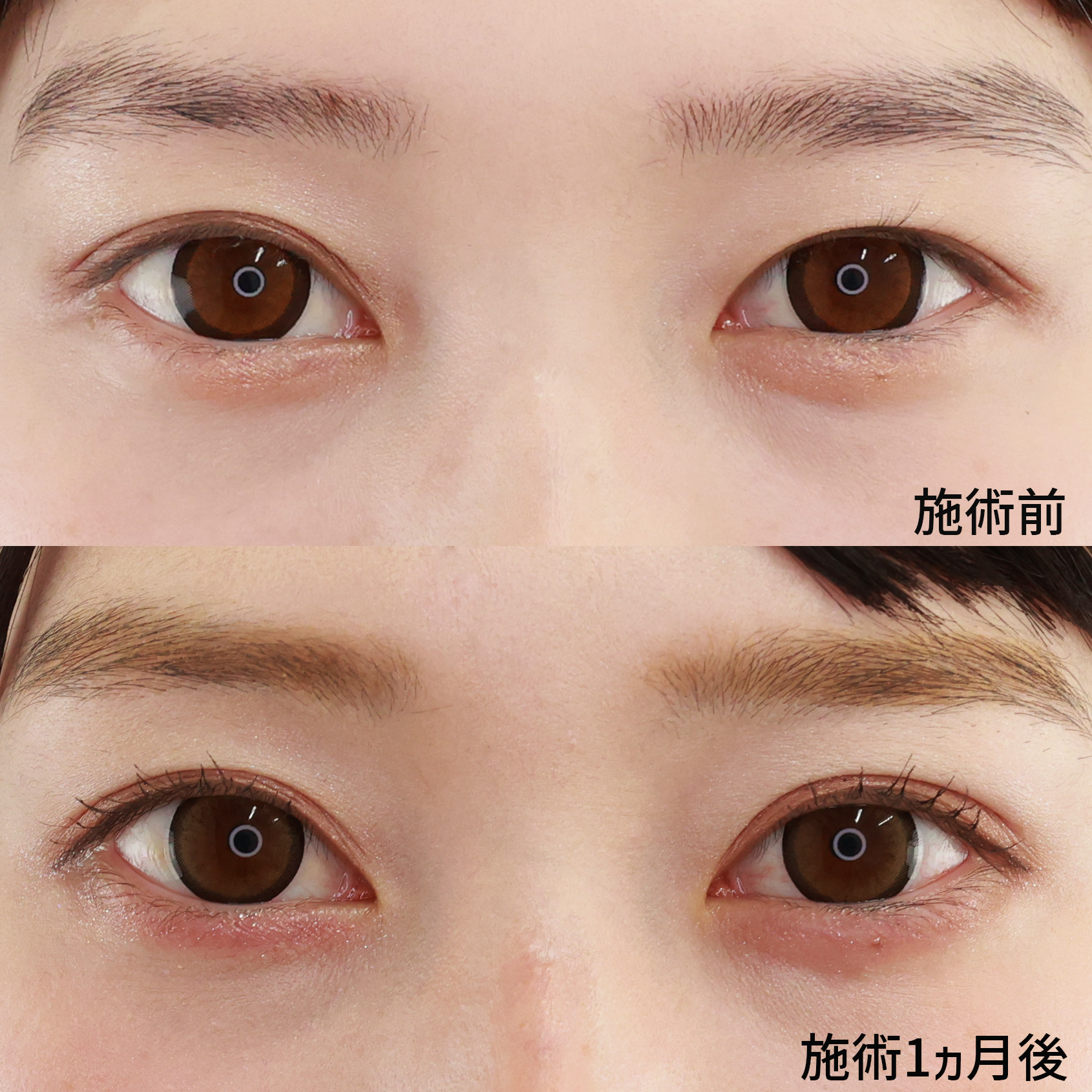片目二重術（片目だけ整形したい方）/二重埋没法の症例写真 施術前後 １ヵ月