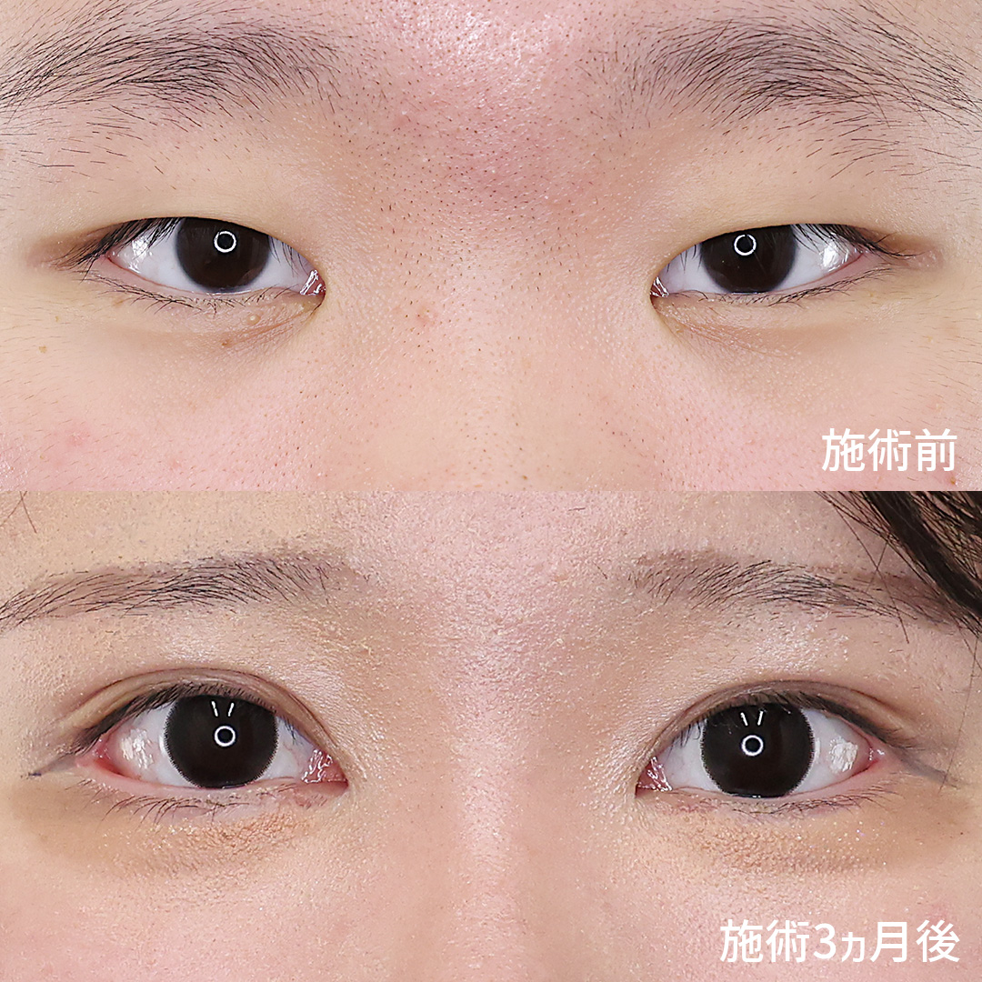 二重埋没法/目尻切開術/目頭切開術の症例写真 施術前後 