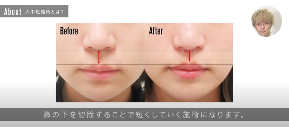 鼻の下を切除することで短くしていく施術になります。