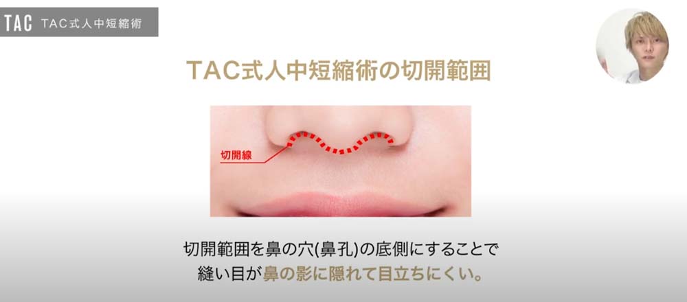 TAC式人中短縮術の切開範囲｜切開範囲を鼻の穴（鼻孔）の底側にすることで縫い目が鼻の影に隠れて目立ちにくい。
