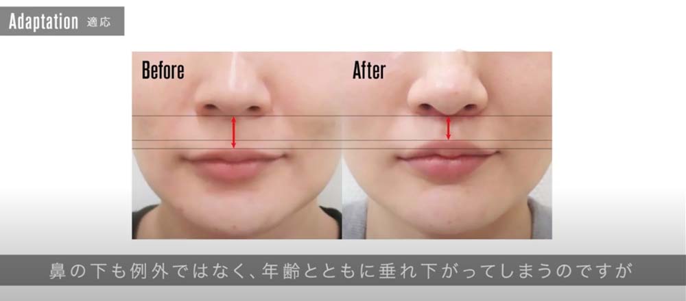 鼻の下も例外ではなく、年齢とともに垂れ下がってしまうのですが