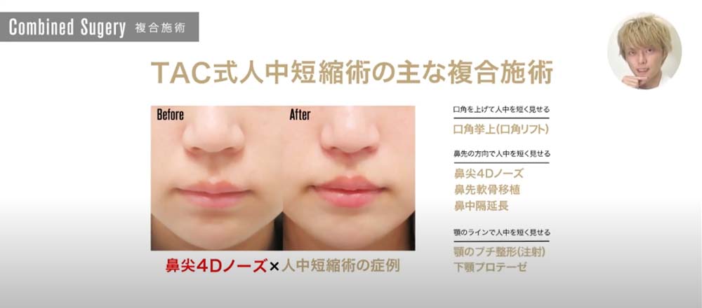 TAC式人中短縮術の主な複合施術｜鼻尖4Dノーズ×人中短縮術の症例