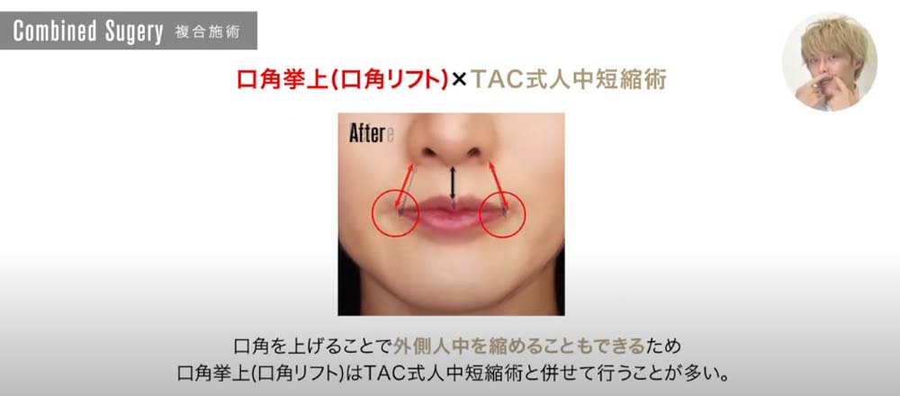 口角拳上（口角リフト）×TAC式人中短縮術｜口角を上げることで外側人中を縮めることもできるため口角拳上（口角リフト）はTAC式人中短縮術を併せて行うことが多い。